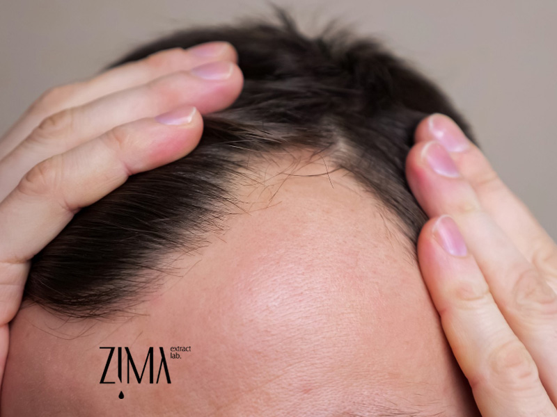 درمان ریزش مو پس از کرونا